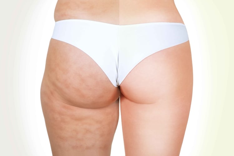 Cellulite bekämpfen | Premium